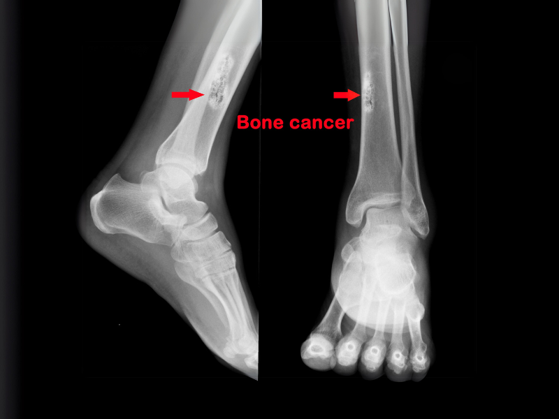 Imagem de raio-x que mostra um caso de câncer de osso.