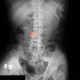 Raio x que mostra o impacto das doenças autoimunes na coluna vertebral