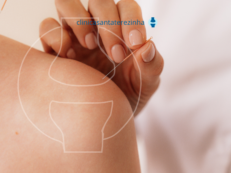 Acupuntura traz benefícios sem causar efeito colateral.